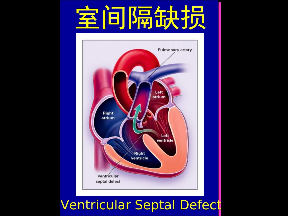 先天性心脏病个论.ppt_第2页