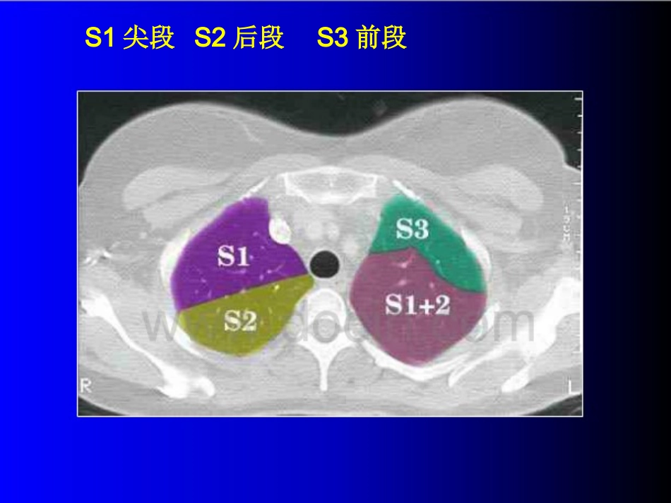 胸部CT读片指南.ppt_第3页