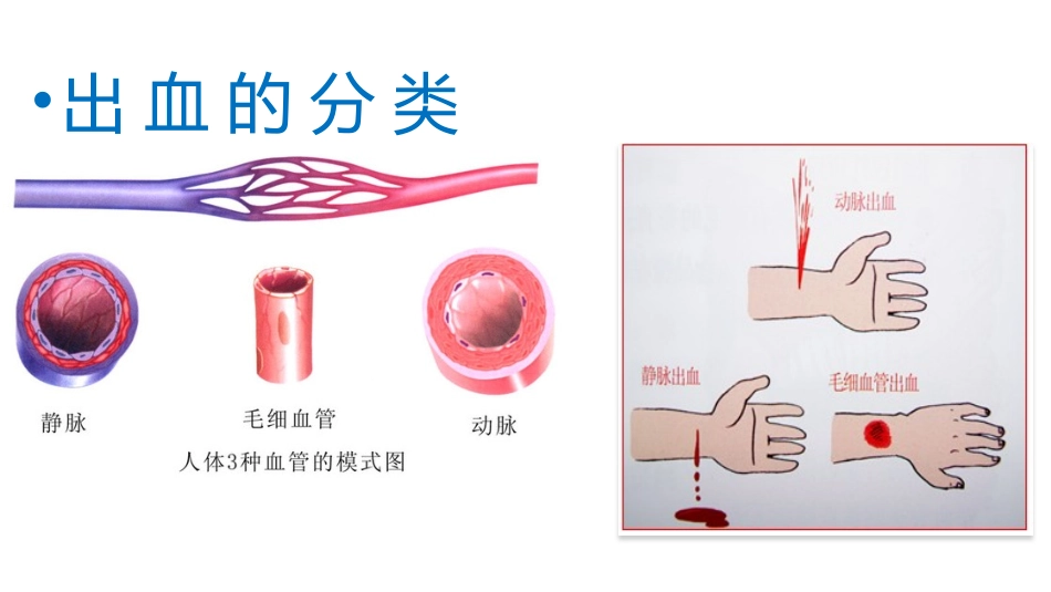 外伤出血的处理(1).pptx_第2页