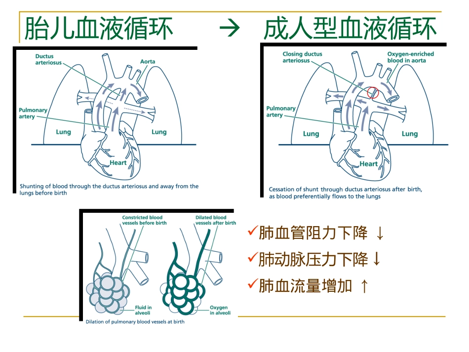 新生儿肺动脉高压.pptx_第3页