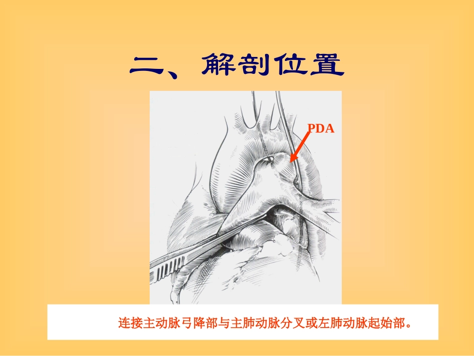 先天性心脏病PDA.ppt_第2页