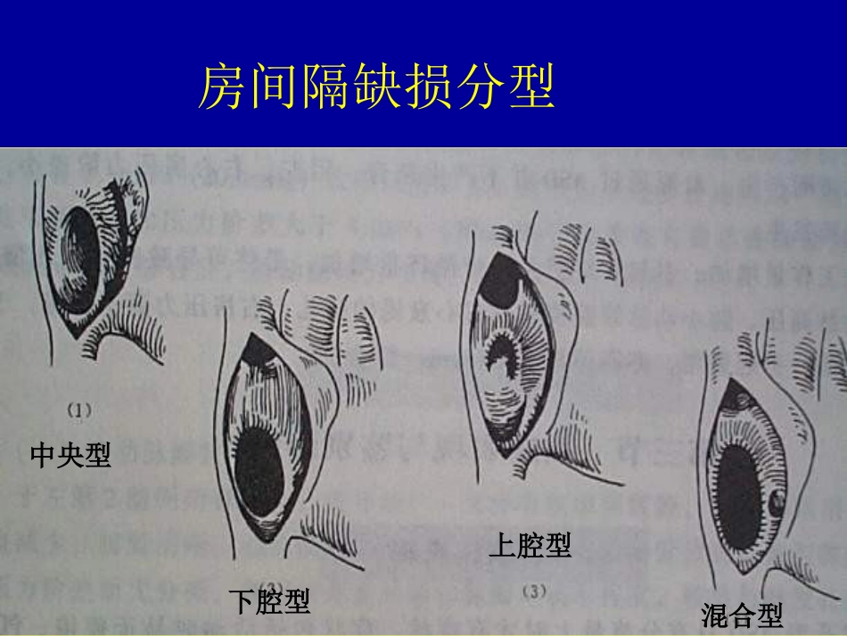 先心病封堵器研制现状概要.ppt_第3页