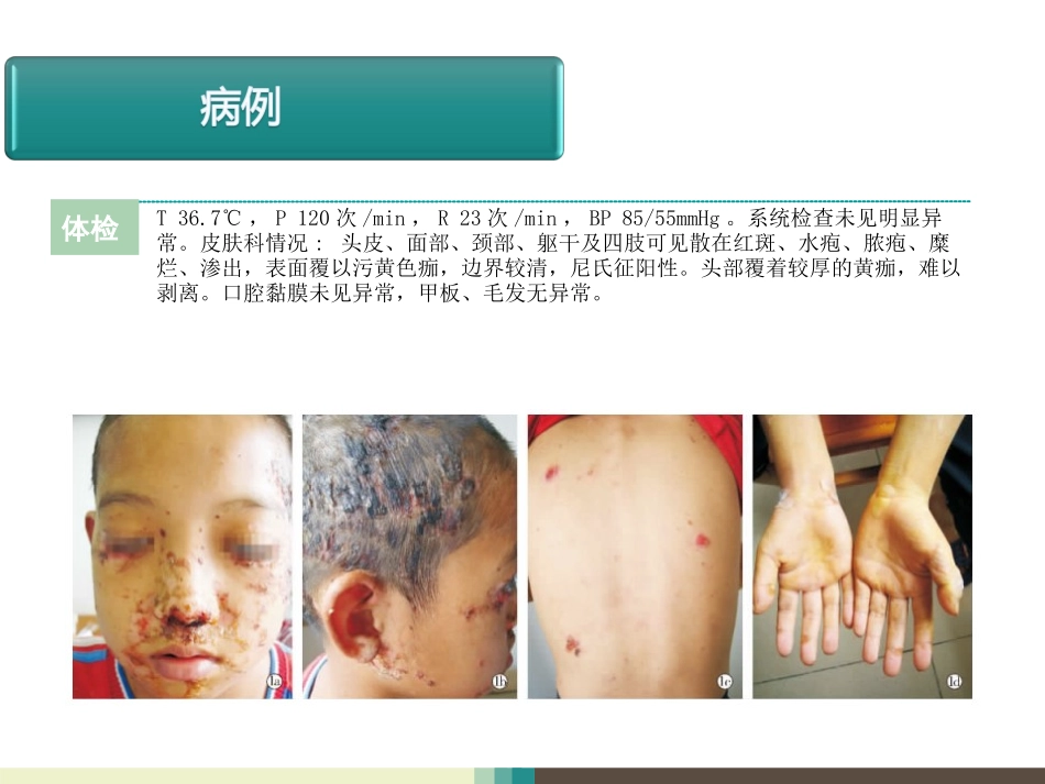 天疱疮病例讨论.ppt_第3页