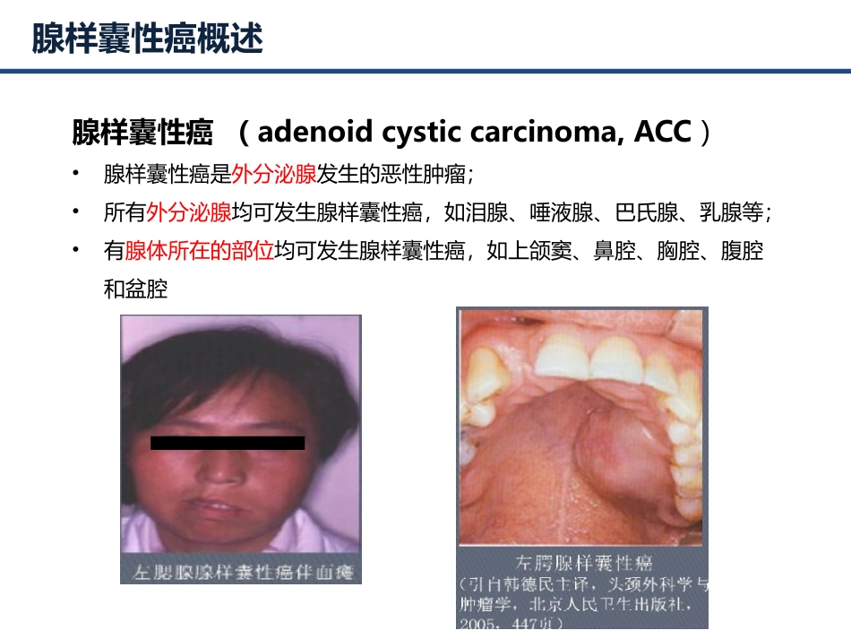 头颈部腺样囊性癌.pptx_第3页