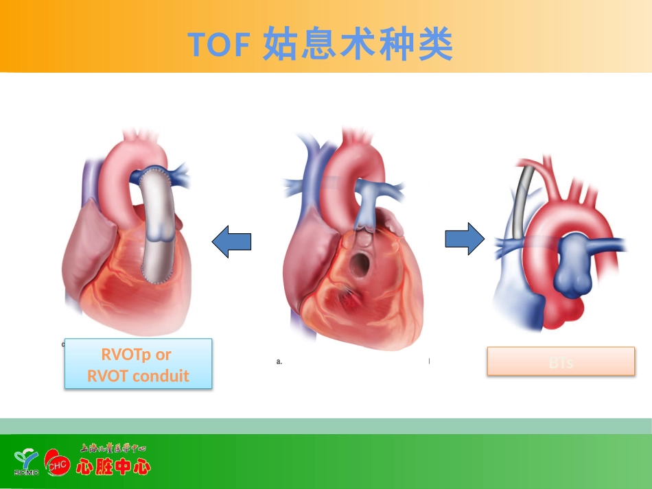 徐卓明-TOF姑息术后监护要点并发症及其处理(1).pptx_第2页