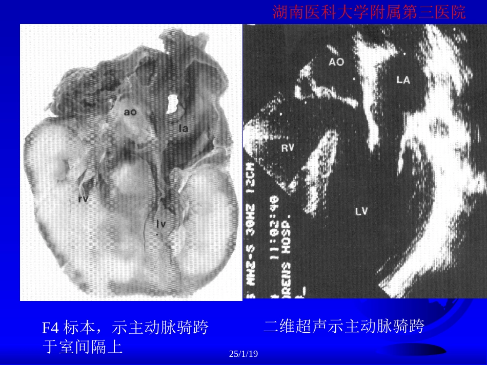 心脏超声检查刘明辉湘雅.ppt_第3页