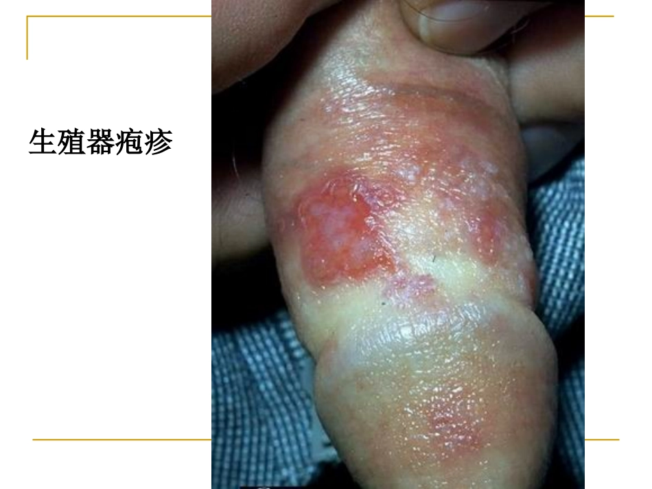 性病的传播途径.ppt_第2页