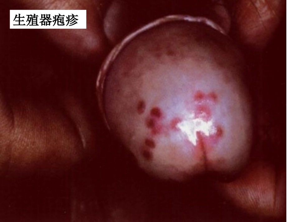 性病的传播途径.ppt_第3页