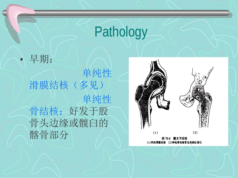 同种异体骨移植在骨科的应用.ppt_第3页