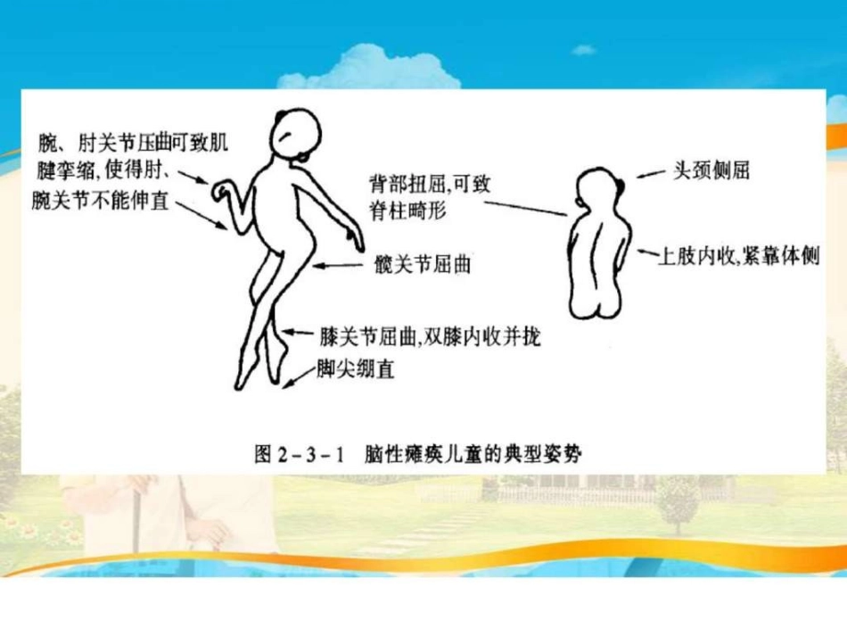 小儿脑瘫的康复训练图文ppt.pptx_第2页