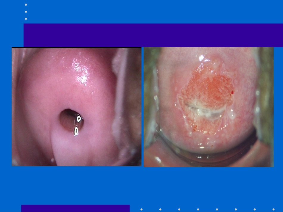 徐爱娣CIN-的诊治.ppt_第2页