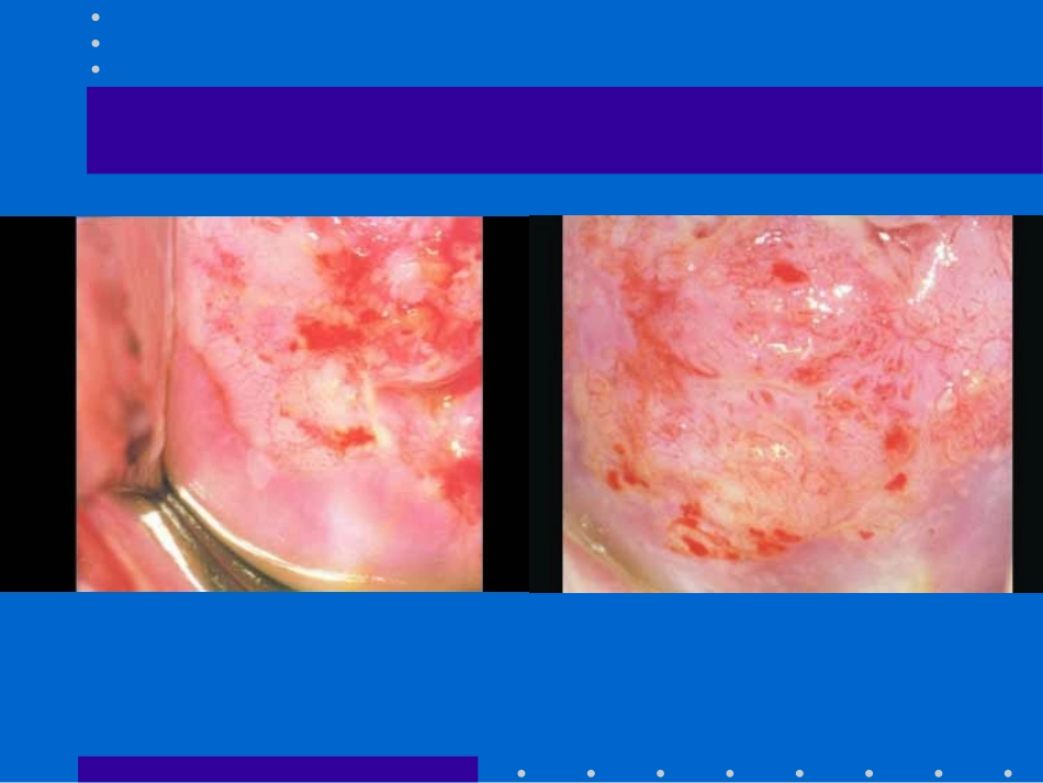 徐爱娣CIN-的诊治.ppt_第3页