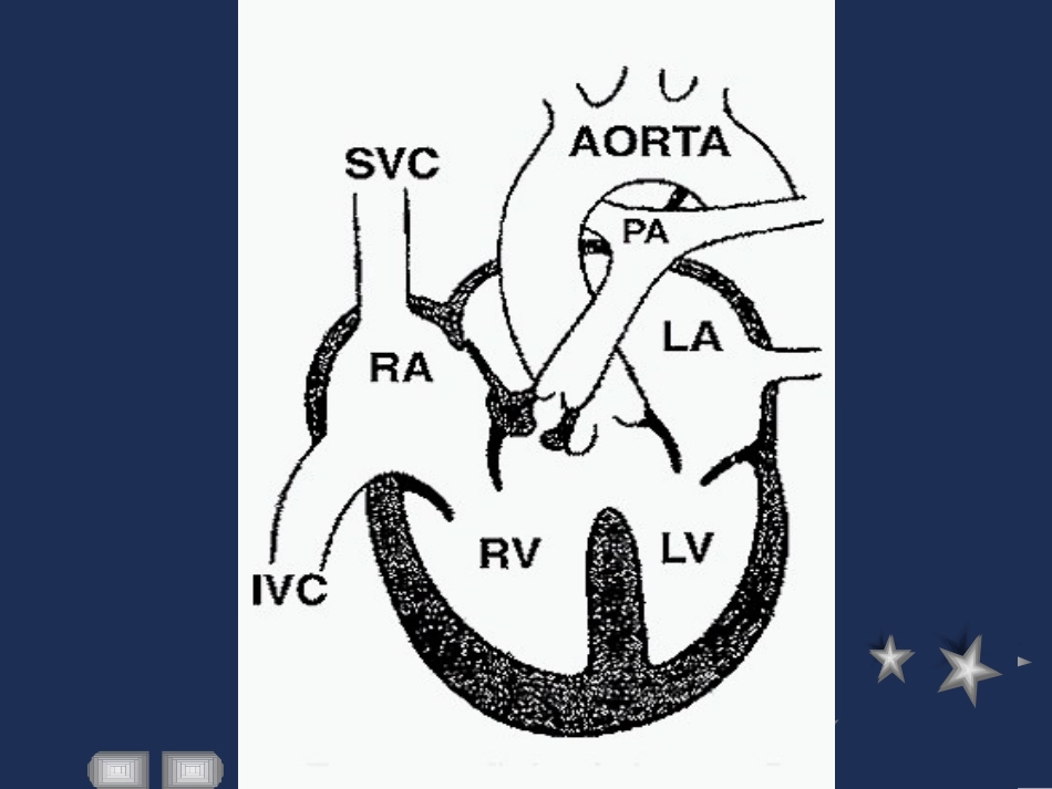 心瓣膜病—本科.ppt_第3页
