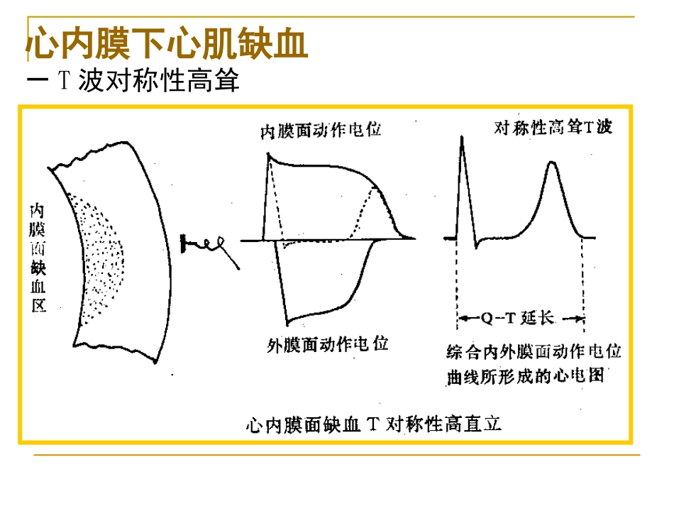 心肌缺血、梗塞.ppt_第2页