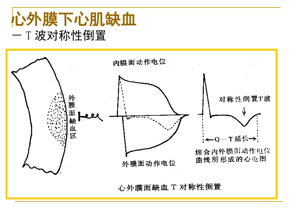 心肌缺血、梗塞.ppt_第3页