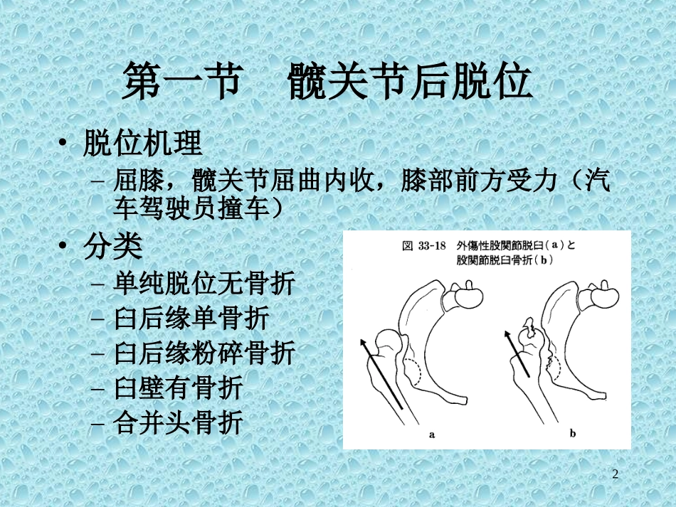 下肢骨、关节损伤.ppt_第2页