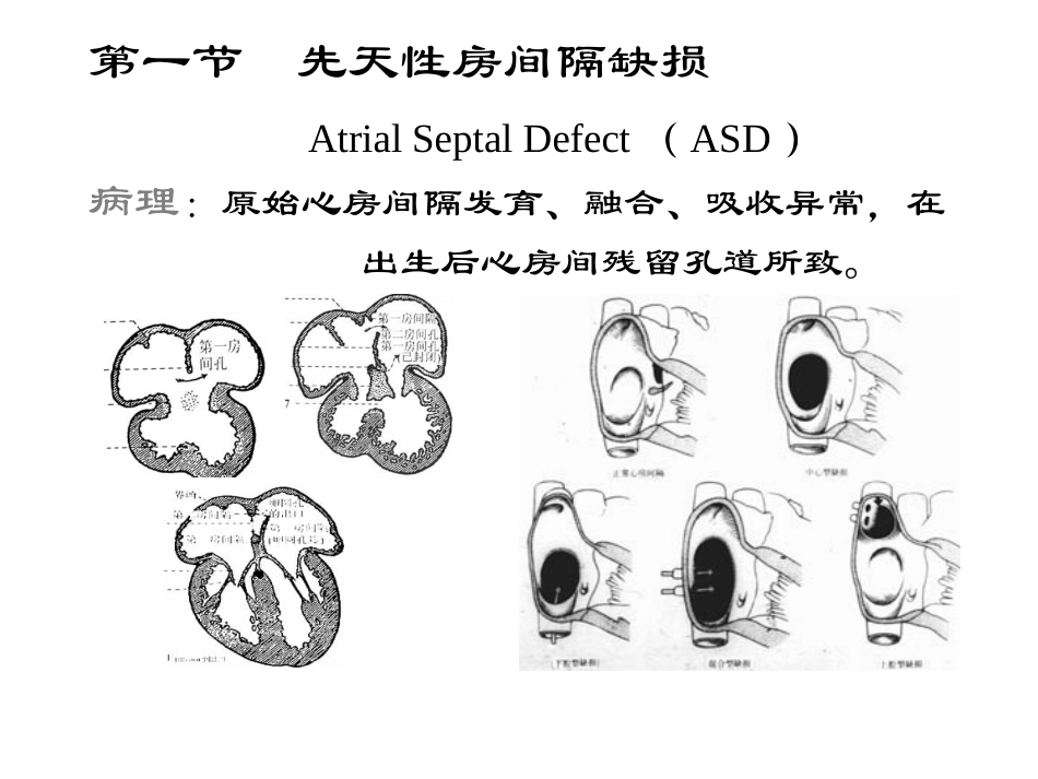 先天性心血管病(精).ppt_第3页