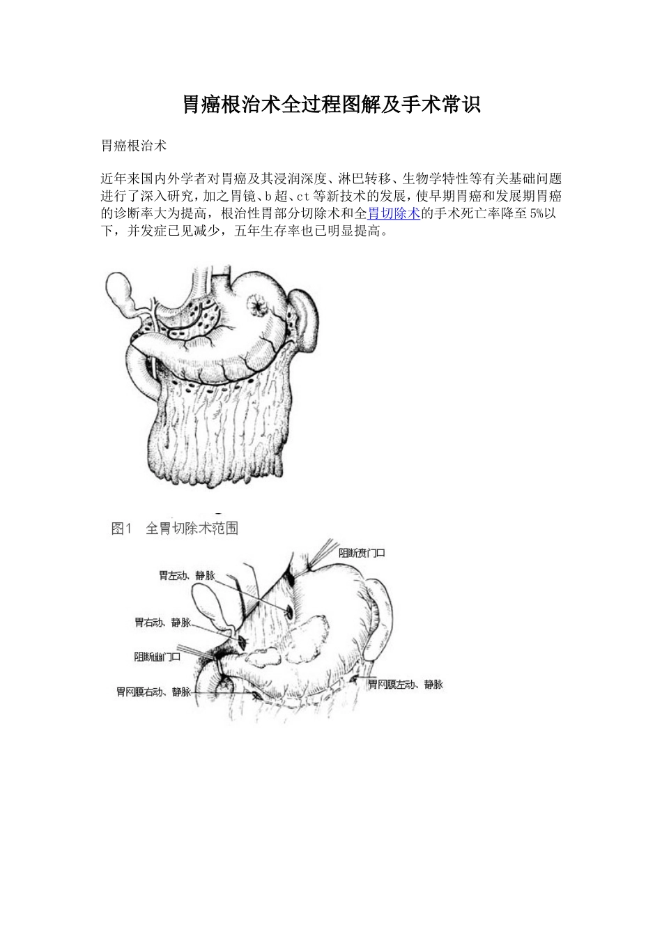 胃癌根治术全过程图解及手术常识.doc_第1页