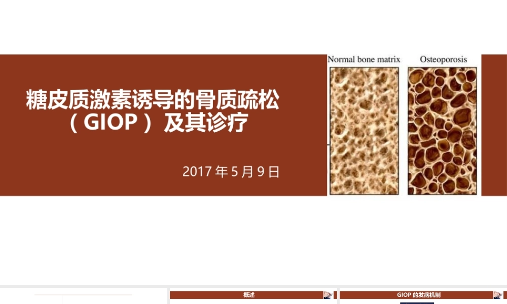 糖皮质激素诱导的骨质疏松.pptx