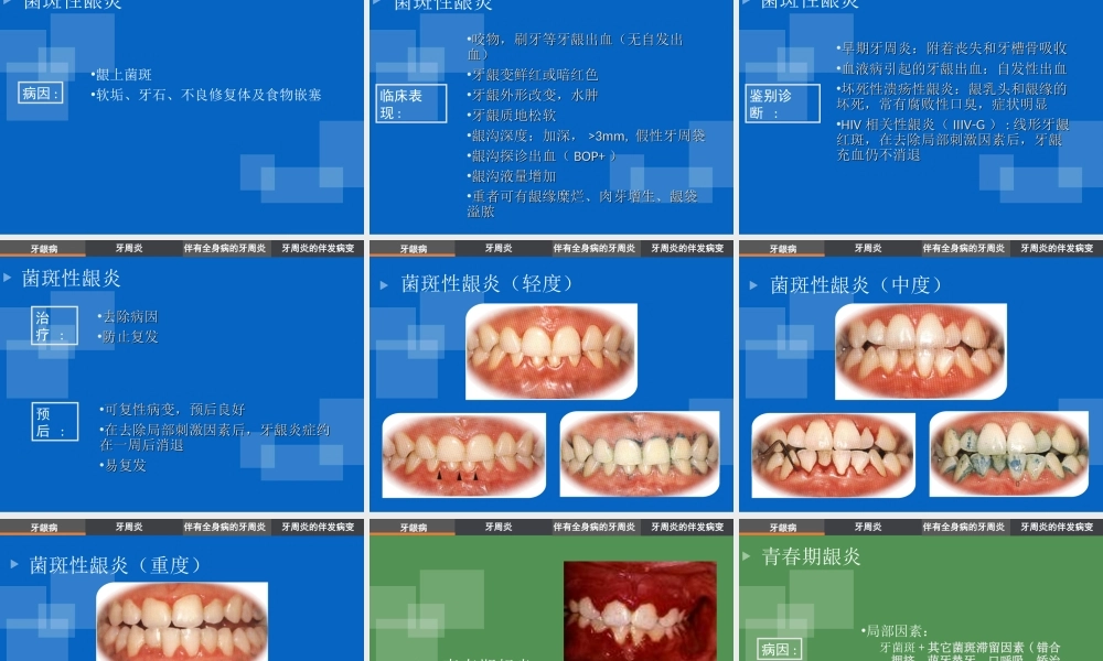 牙周病分类及龈炎各论.ppt