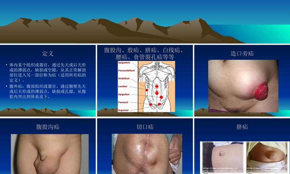 疝和腹壁外科进展.ppt