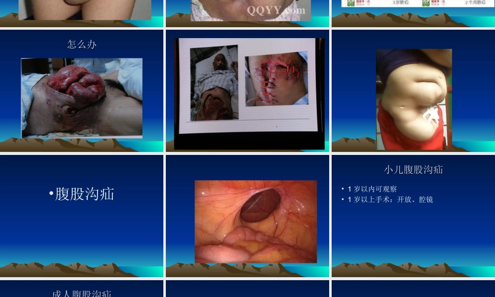 疝和腹壁外科进展.ppt