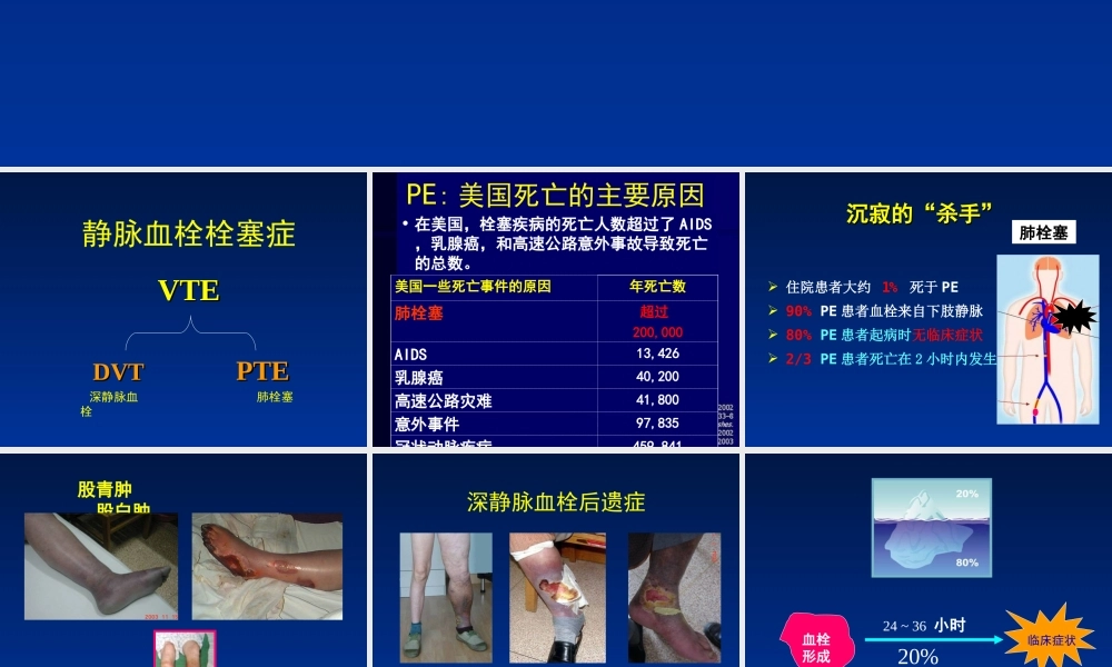 深静脉血栓防治策略..ppt