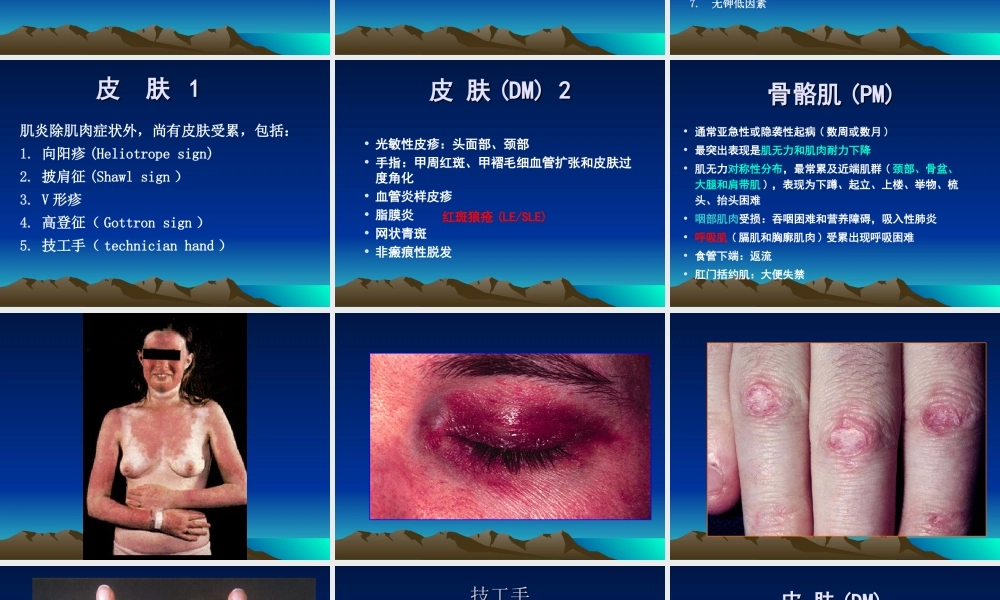 炎性肌病要点.ppt