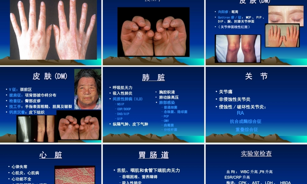 炎性肌病要点.ppt