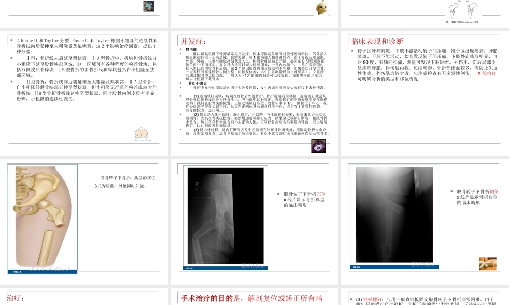 浅谈股骨转子下骨折.ppt