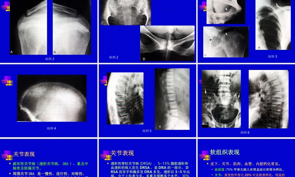 甲状旁腺功能亢进的骨骼影像学.ppt