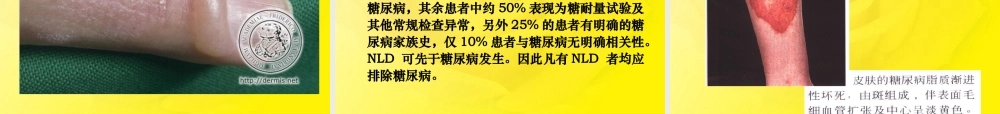 糖尿病与皮肤病.ppt