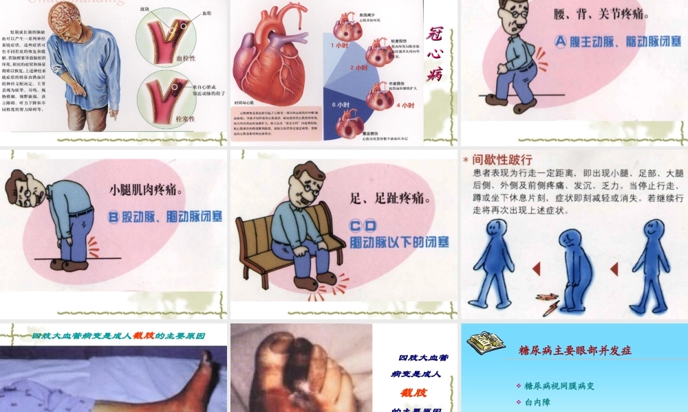 糖尿病慢性并发症的防治(2013-12-07继教会议用).ppt