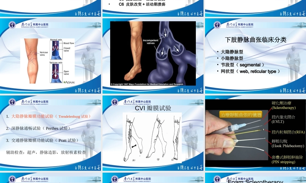 泡沫硬化剂与静脉曲张.ppt