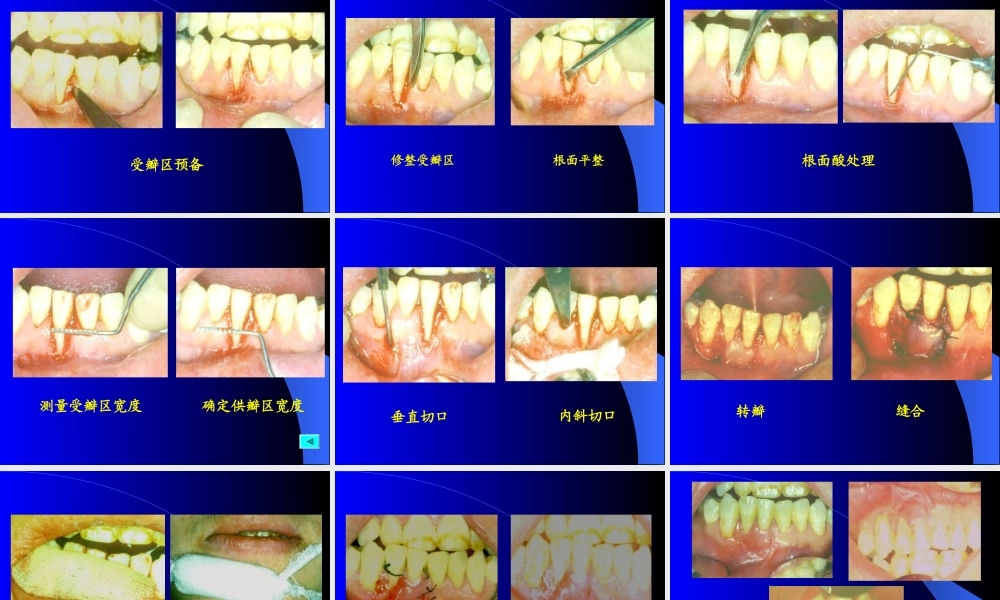 牙周手术1.ppt