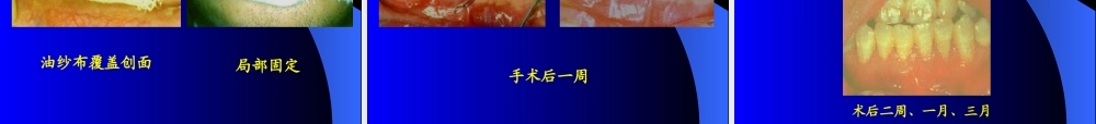 牙周手术1.ppt