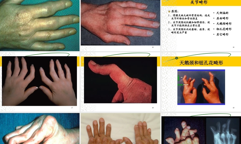 李秋平-类风湿关节炎1已改.ppt