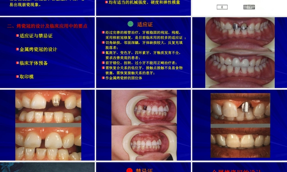 烤瓷熔附金属全冠修复成功的关键要素南京医科大学附属口腔医院.ppt