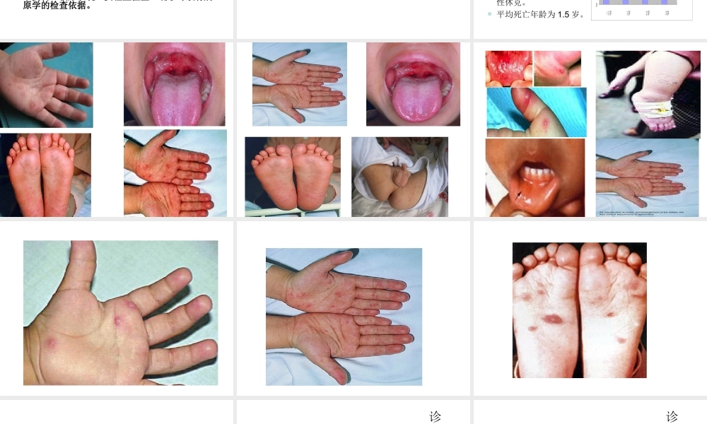 手足口病防治(演讲版).ppt