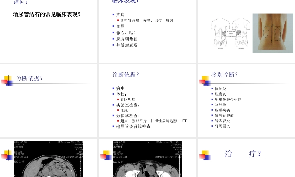 教学查房输尿管结石.ppt