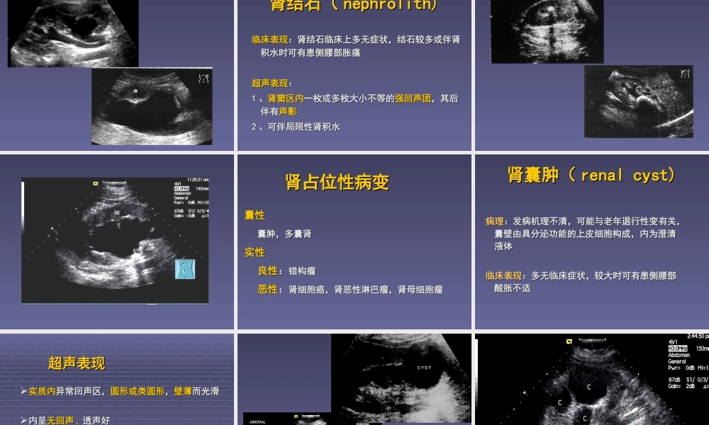 泌尿系统超声检查.ppt