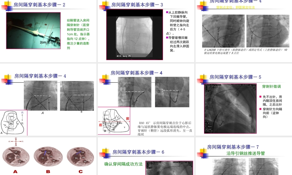 房间隔穿刺术李述峰-.ppt