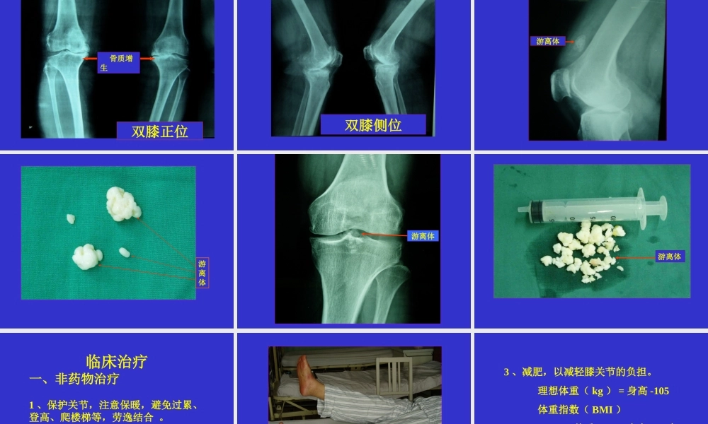 朝鲁门-老年性骨关节病.ppt