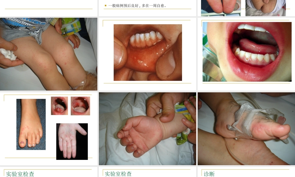 手足口病(1).ppt