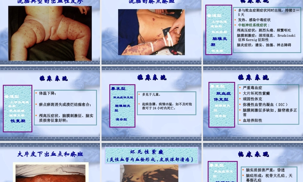 流行性脑脊髓膜炎知识要点.ppt