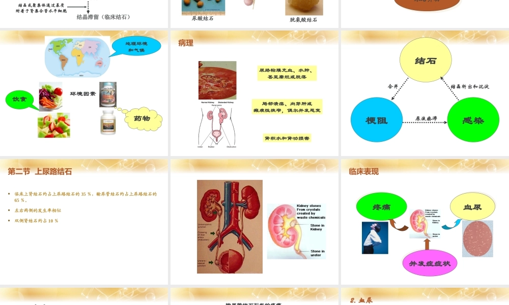 泌尿系结石.ppt