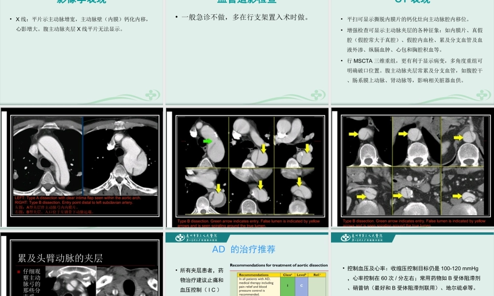 急性主动脉综合征的诊疗进展.ppt
