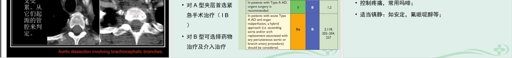 急性主动脉综合征的诊疗进展.ppt
