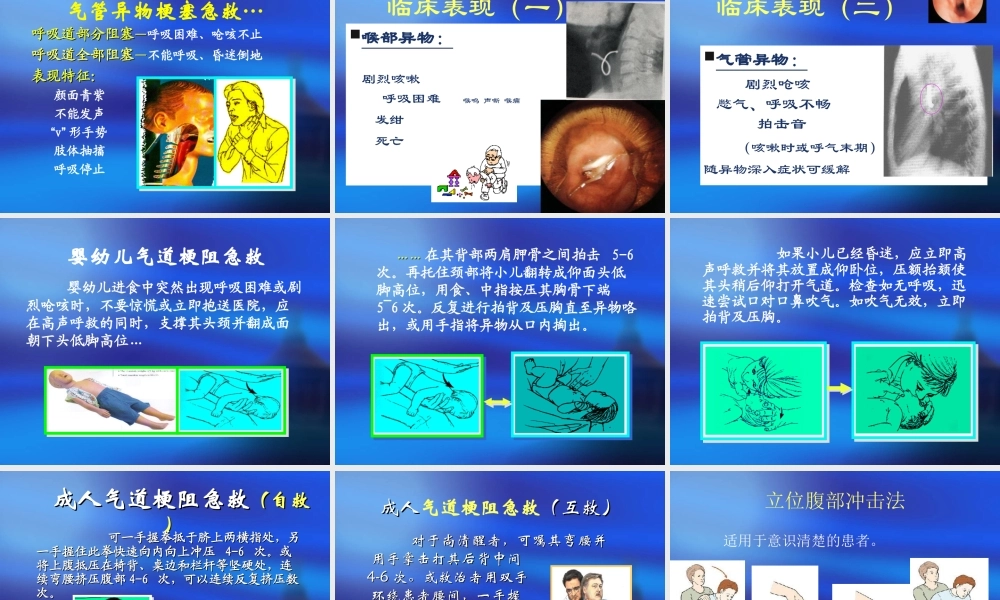 急性呼吸道梗阻.ppt
