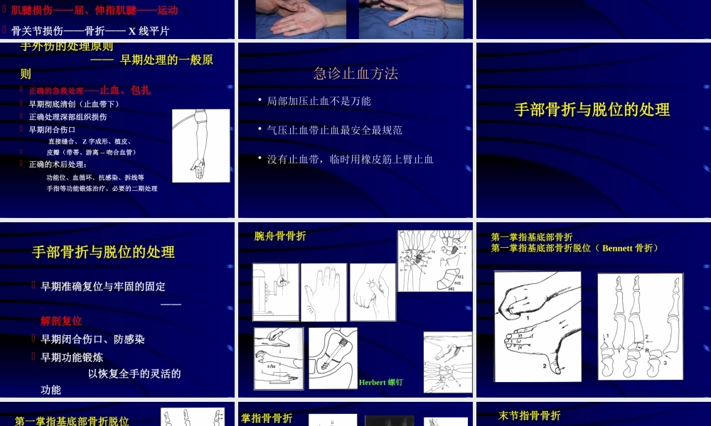 手外伤诊治与康复1.pptx